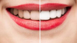 کامپوزیت دندان چیست؟ آشنایی کامل با کامپوزیت دندان و بررسی مراحل و کاربرد آن