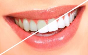 بلیچینگ دندان چیست؟ + معرفی انواع بلیچینگ دندان