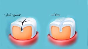فیشور سیلانت چیست و چه کاربردی دارد؟ + آیا فیشور سیلانت دندان کودک درد دارد؟