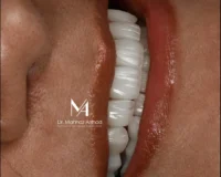 مراحل درمان لمینیت دندان به زبان ساده